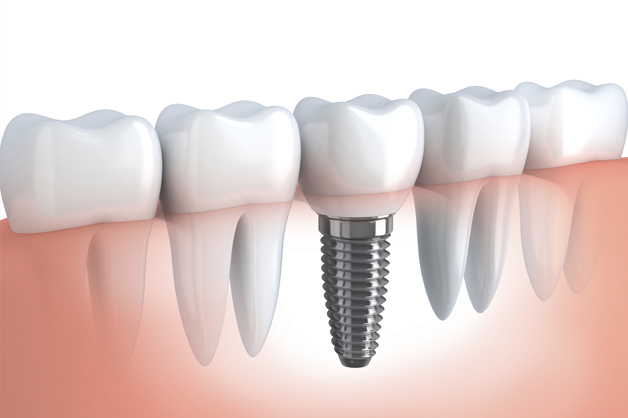 implante-dentario